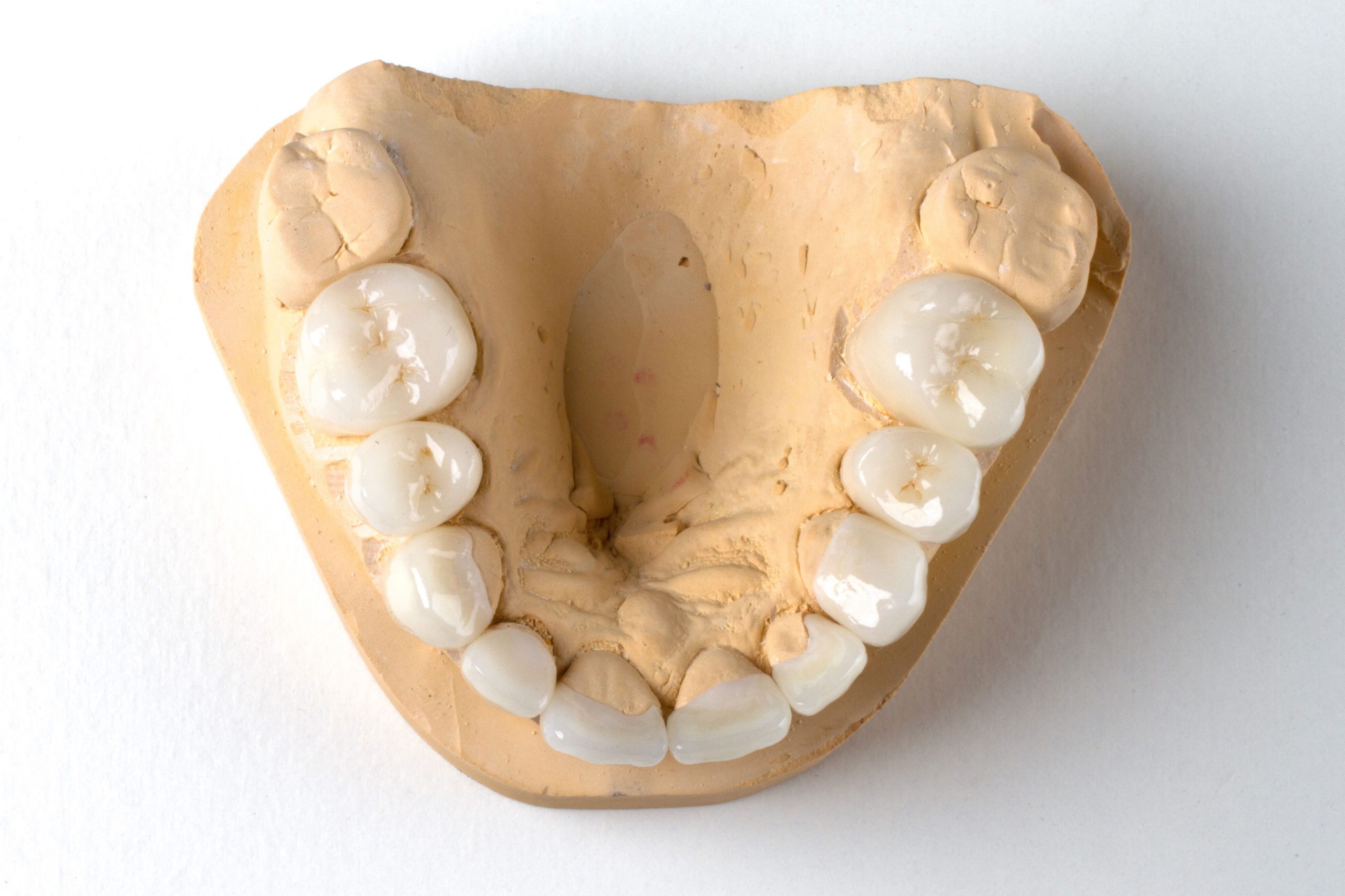 dental crowns