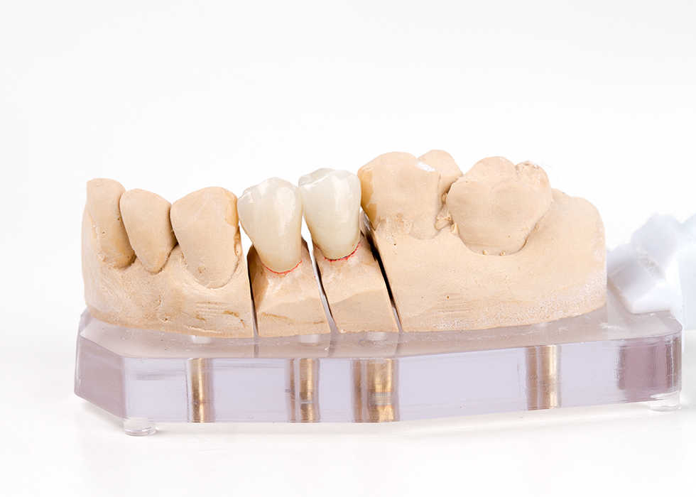 occlusal view denture