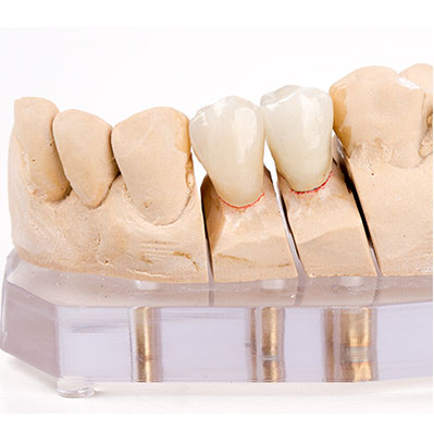 zirconia crown