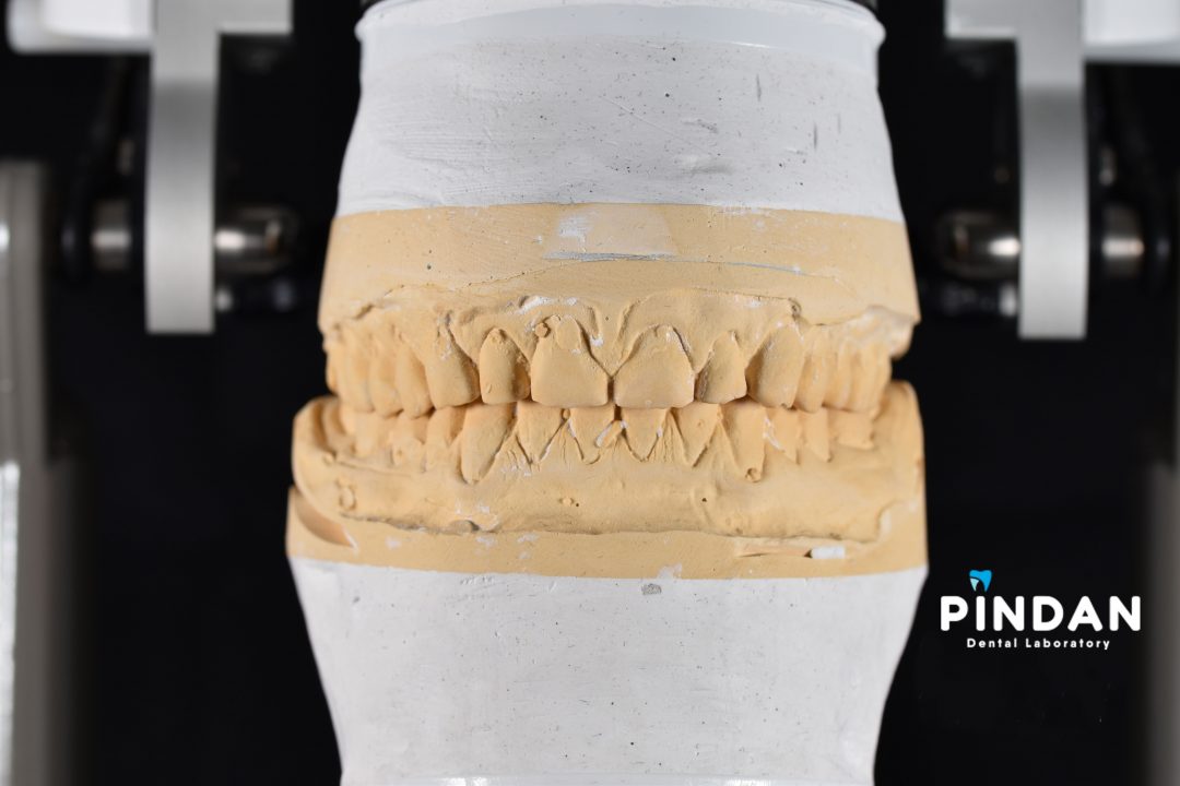 diagnostic waxup planning dental