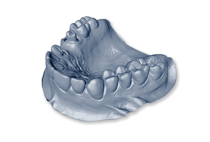 occlusal view denture